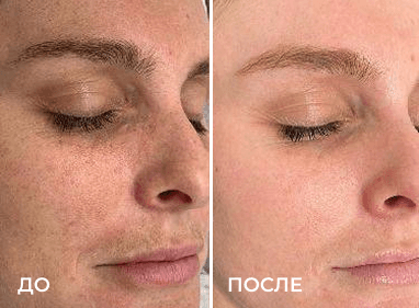 Сравнение до и после из раздела «Фотоомоложение», пример 2