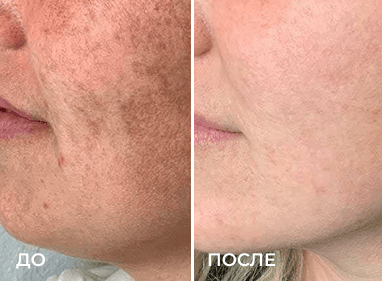 Сравнение до и после из раздела «Фотоомоложение», пример 6