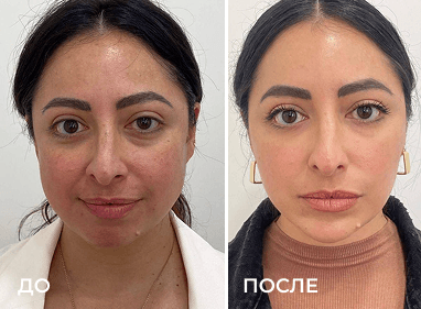 Сравнение до и после из раздела «Фотоомоложение», пример 7