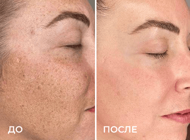 Сравнение до и после из раздела «Фотоомоложение», пример 8