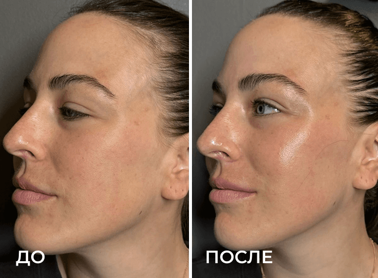 Сравнение до и после из раздела «Фотоомоложение», пример 10